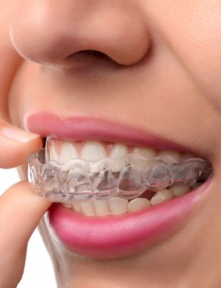 Invisalign Metuchen - House of Dentistry