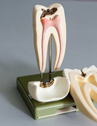 Root Canals Metuchen - House of Dentistry