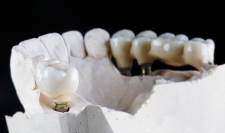 care for your dental bridges and maintain oral health